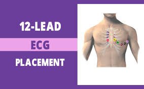 12 lead ecg placement