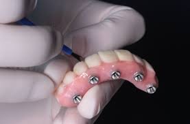 all on four dental implants